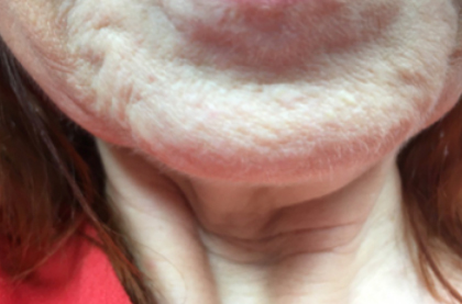 pouting before treatment showing deep lines above lips 