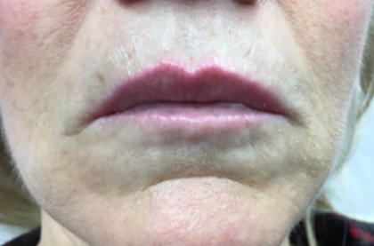 pouting before treatment showing deep lines above lips 