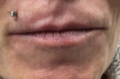 pouting before treatment showing deep lines above lips 