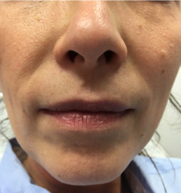 pouting before treatment showing deep lines above lips 