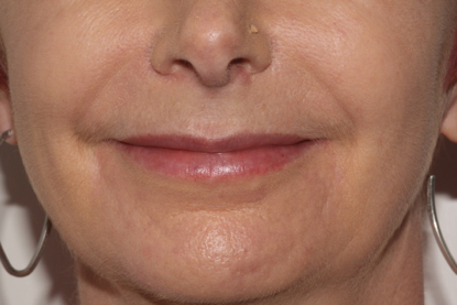 patient smiling after treatment showing softer nose to mouth lines