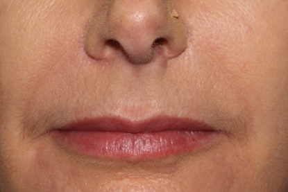 patient smiling after treatment showing softer nose to mouth lines
