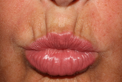 pouting before treatment showing deep lines above lips 