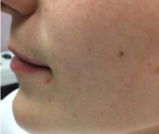 pouting before treatment showing deep lines above lips 