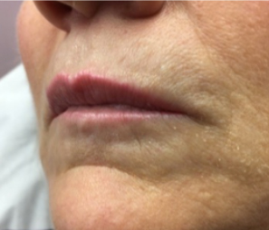 pouting before treatment showing deep lines above lips 